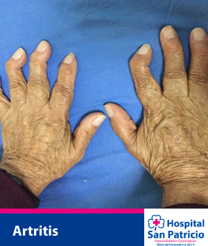artritris