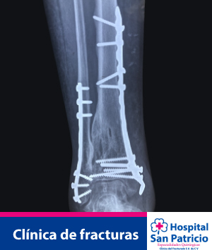 Clinica de fracturas
